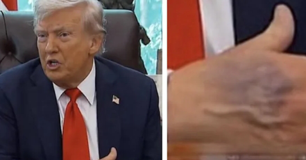 Bàn tay thâm tím của ông Trump gây chú ý