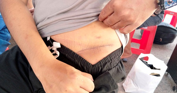 Nam thanh niên sang Campuchia làm “việc nhẹ lương cao” bị cưỡng ép cắt bỏ một quả thận: Vết sẹo dài bên mạn sườn gây ám ảnh